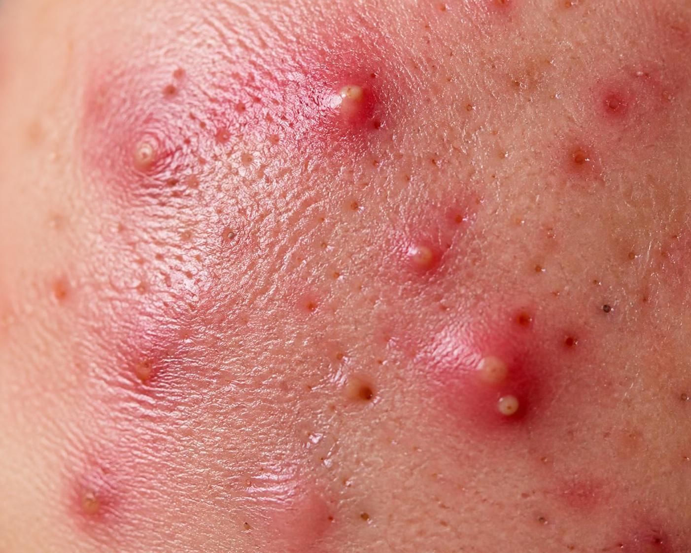 découvrez comment le cbd peut transformer votre routine de soins contre l'acné grâce à ses propriétés apaisantes et régénérantes, pour une peau plus saine et éclatante.
